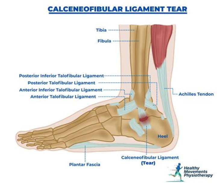 What is a sprain of the Calcaneofibular