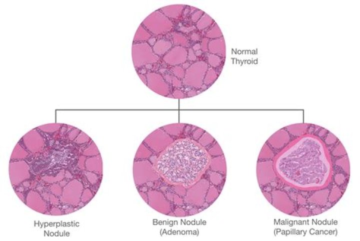 What is adenomatous nodule thyroid?