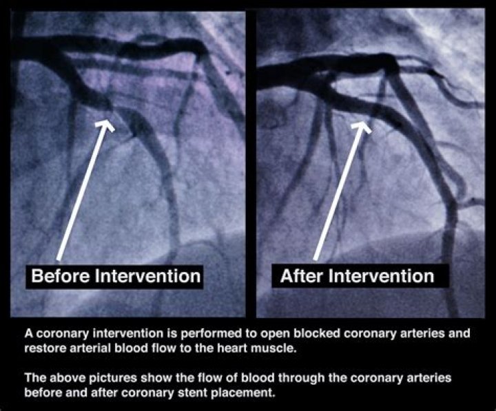 What is an arteriogram of lower extremity?