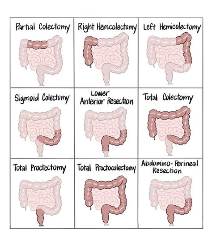 What is an open colectomy?