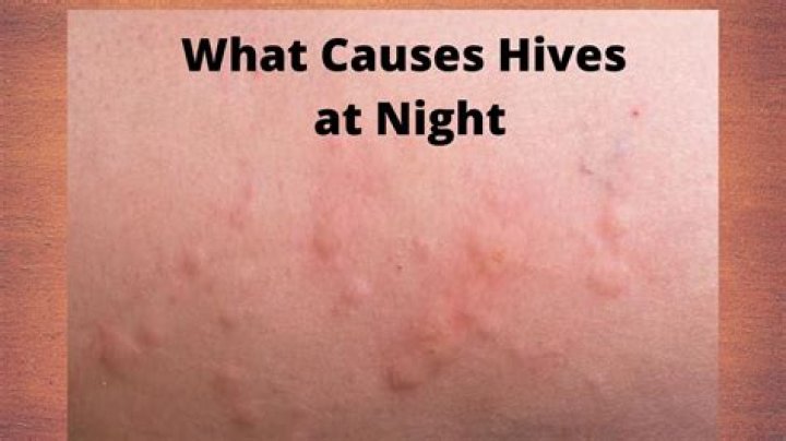 What is causing hives at night?