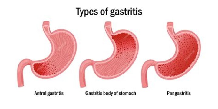 What is gastric antrum erosion?