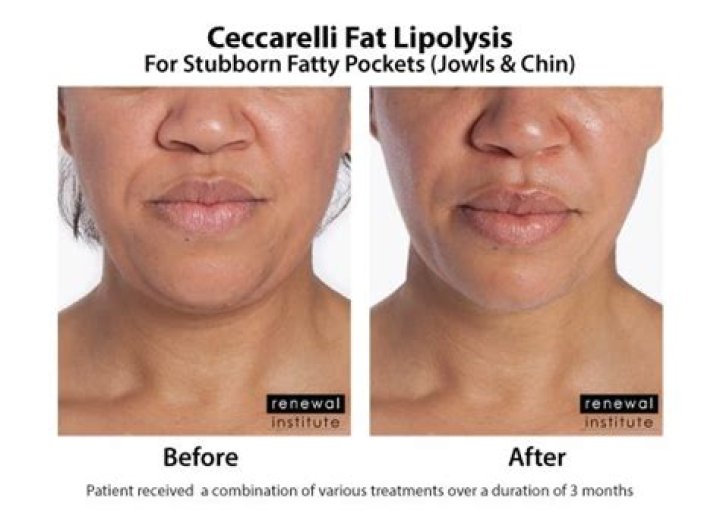 What is lipolysis treatment