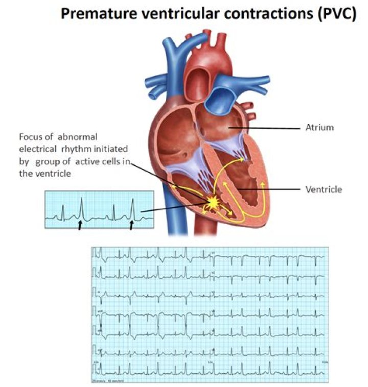 What is PAPVC in cardiology?