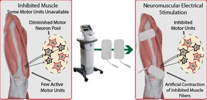 What is percutaneous neuromuscular electrical stimulation?