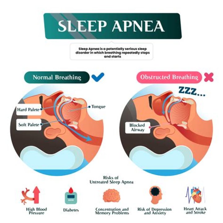 What is sleep apnea mean