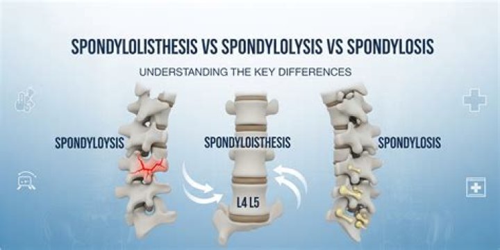 What is the difference between spondylolisthesis and Anterolisthesis?