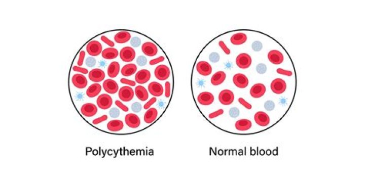 What is twin anemia polycythemia?