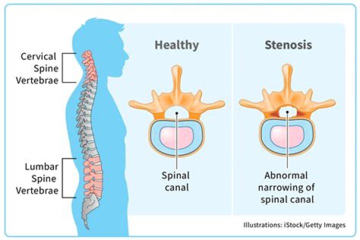What percentage of spinal stenosis surgeries are successful?