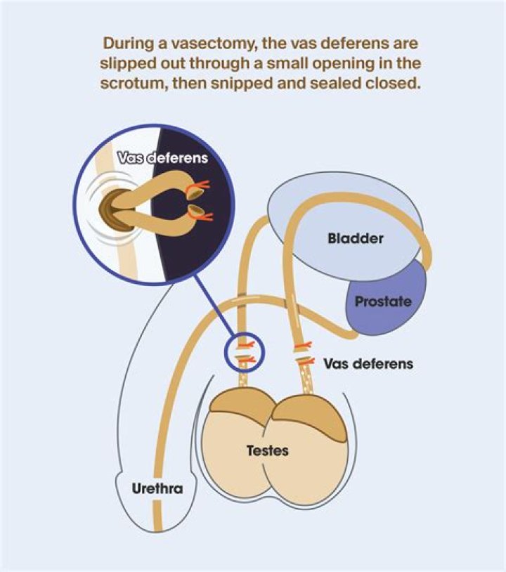 What percentage of vasectomies are reversible?