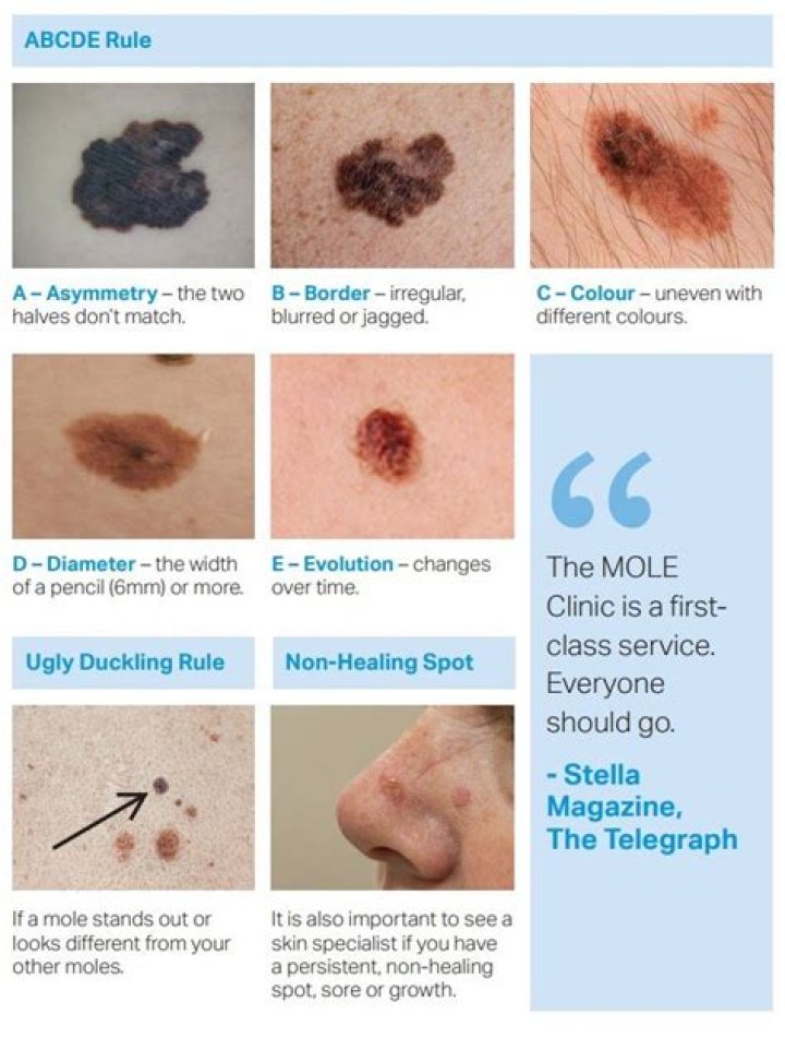 What to look for in moles