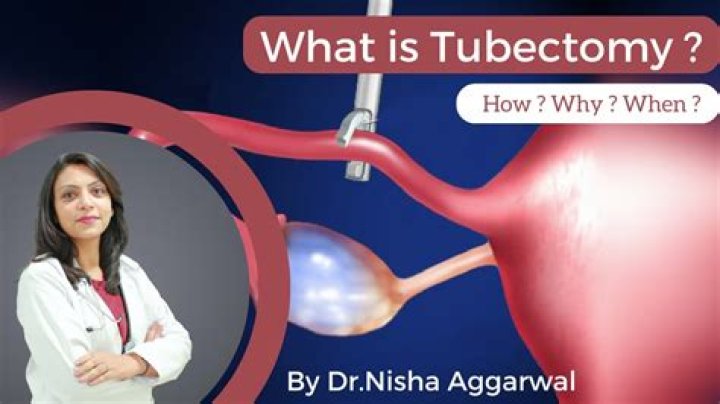Which is better tubectomy or vasectomy?