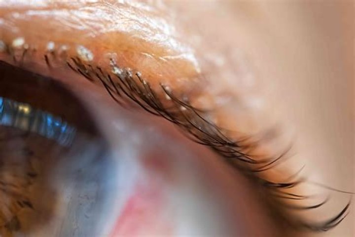 Why do I pull my eyelashes off?