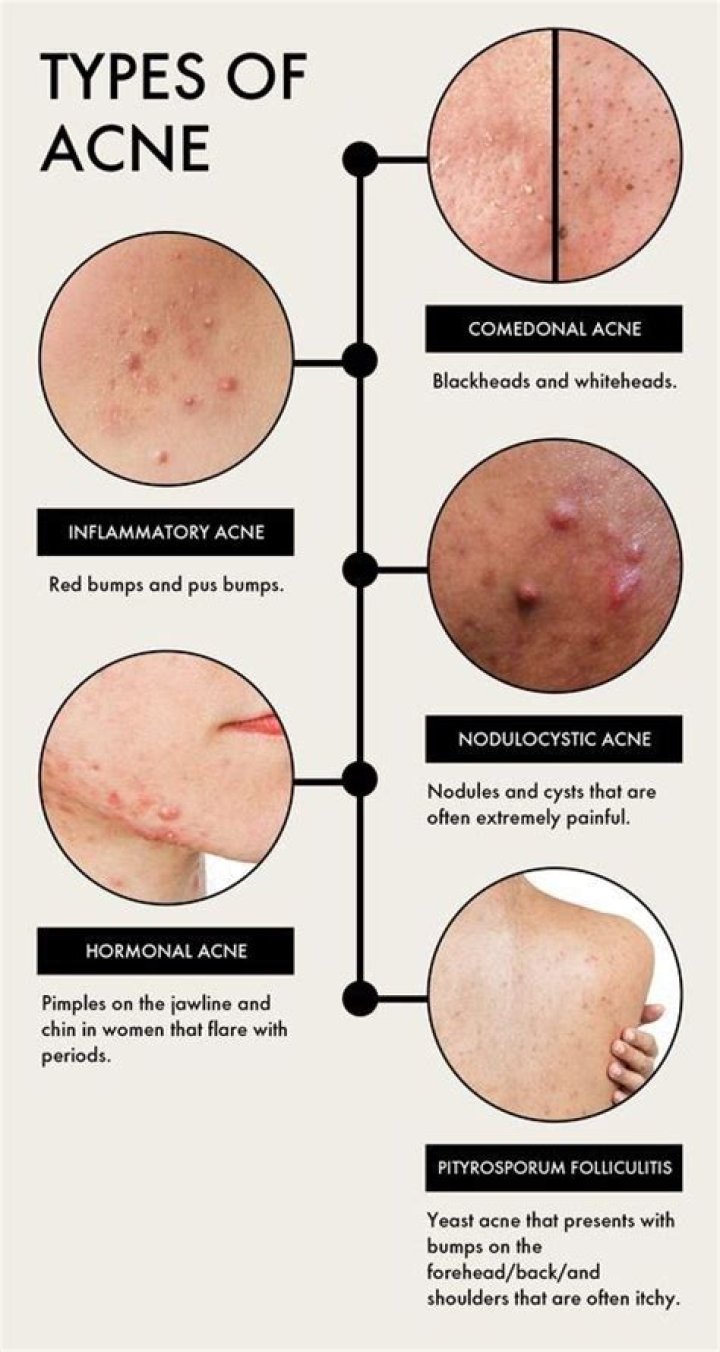 Why does acne appear at night?